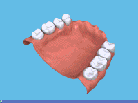 Fixirung der Zahnprothese