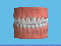 Überkronung eines hinteren Zahnes beim Zahnarzt in Moson