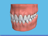 Zahnprothese mit Steg auf Implantate