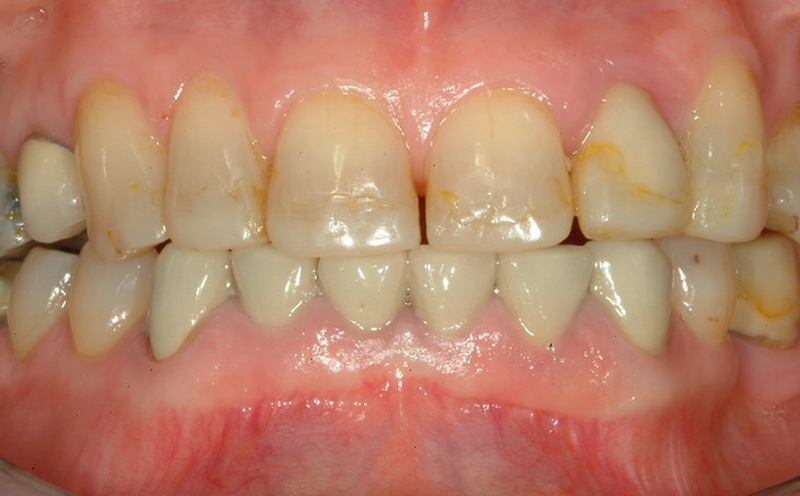 Die Zähne vor der Zahnbehandlung