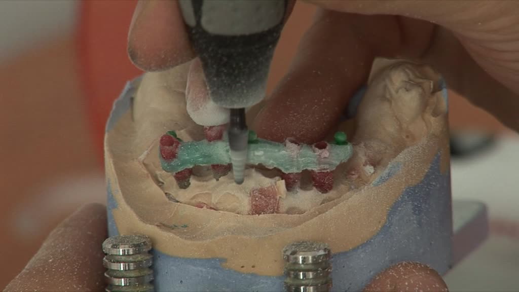 Stegprothese Anfertigung im Zahntechniklabor