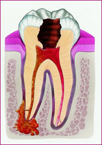 Entzündung des Zahnnervs, die meist durch Karies verursacht wird.