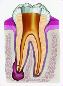 Trepanation: der Zahnarzt entfernt die kariösen Stellen am Zahn und schafft mit dem Bohrer einen Zugang zur Pulpa.