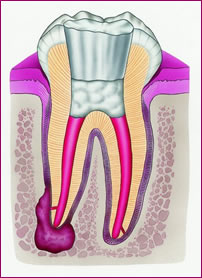Wurzelkanalaufbereitung: der Zahnarzt säubert zuerst den Wurzelkanal und füllt ihn anschließend dicht.