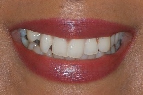 Zähne vor der Zahnbehandlung